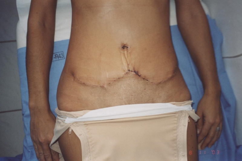 Pooperačné hojenie rán Pooperačné hojenie rán