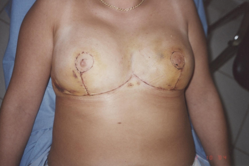 Pooperačné hojenie rán Pooperačné hojenie rán